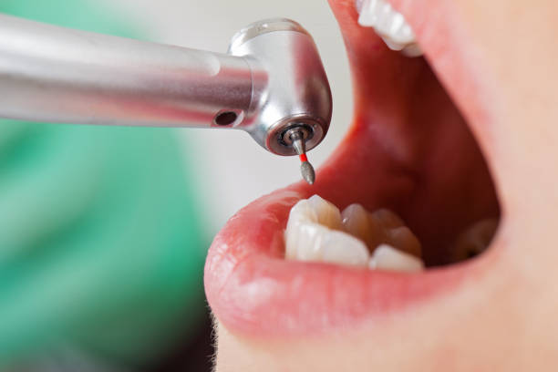 Best Emergency Wisdom Teeth Removal in Everett, MA